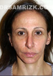 Female patient after Facelift procedure - pic
