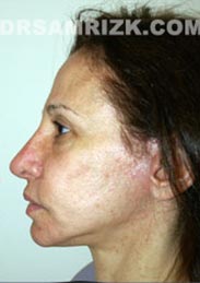 Female patient after Facelift - image