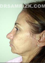pic Female before Facelift