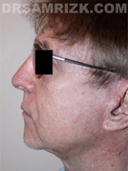 Male Facelift after picture