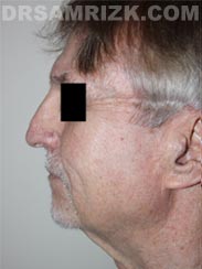 Male Facelift before picture