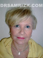 NYC Facelift procedure Female after