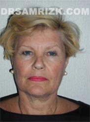 Female before Facelift procedure