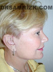 image Female after Facelift procedure