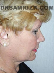 NYC Facelift procedure Female before pic