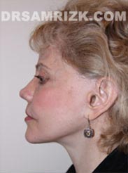 pic Female after Facelift procedure