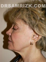 Female before Facelift procedure - pic