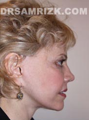 picture Female after Facelift procedure