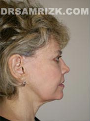 photo patient before Facelift procedure