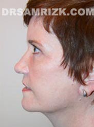 Female after Facelift - side view