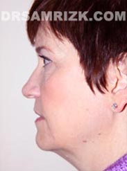 Female before Facelift - side view