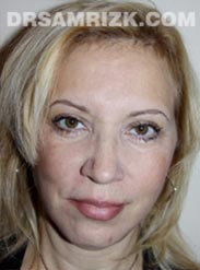 Female after Facelift procedure - front view