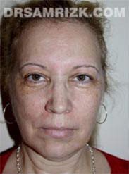 Female before Facelift - front view