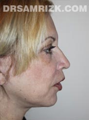 after Facelift procedure women image