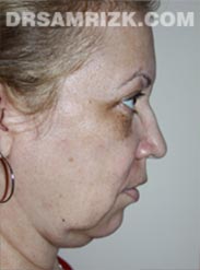 before Facelift procedure women image