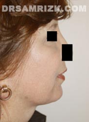 picture Female patient after Facelift procedure