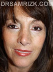 Female after Facelift procedure - frontal view