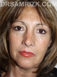 Female before Facelift procedure - frontal view