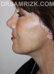 Female after Facelift procedure - side pic
