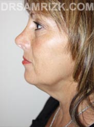 Female before Facelift procedure - side pic