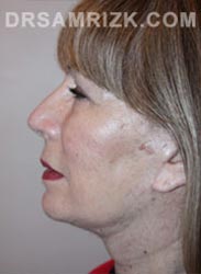 Female Postoperative Facelift procedure - side view