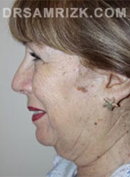 Female Preoperative Facelift procedure - side view
