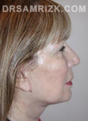 Female patient after lower Facelift procedure - pic