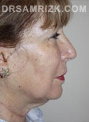 Female patient before lower Facelift procedure - pic