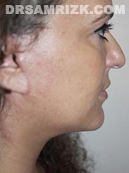Female patient after Facelift procedure - photo