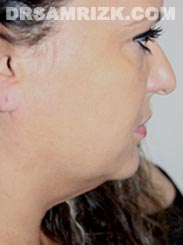 Female patient before Facelift procedure - photo