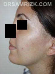 Female patient Post-Op Facelift procedure - photo