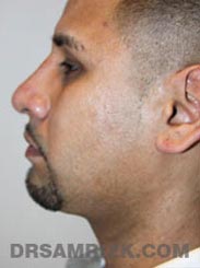 Male patient Post-Op Facelift procedure - side photo
