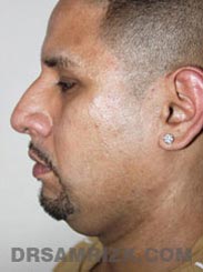 Male patient Pre-Op Facelift procedure - side photo
