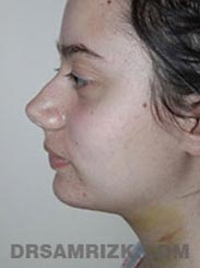 Female patient Facelift procedure Postoperative pic