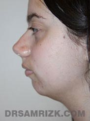 photo patient before Facelift