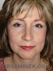 Facelift procedure after - image
