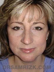 image Female before Facelift procedure