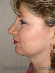 front view Female patient Post-Op Facelift procedure