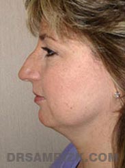 front view Female patient Preoperative Facelift procedure