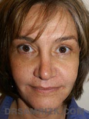 Female patient Post-Op Facelift procedure - pic