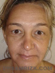 Female patient Facelift procedure Preoperative pic