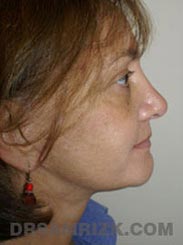 pic Female Postoperative Facelift