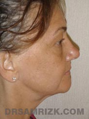 picture Female Pre-Op Facelift