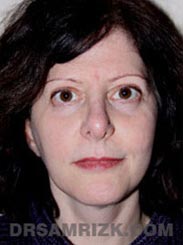 picture Female Postoperative Facelift