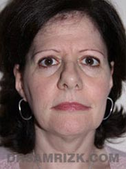 picture Female Preoperative Facelift