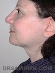 Female patient Post-Op Facelift procedure - side view