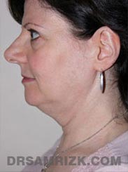 Female patient Pre-Op Facelift procedure - side view