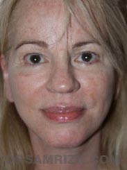 Female after Facelift procedure - photo