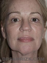 pic Female Pre-Op Facelift