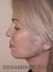 Female patient Postoperative Facelift procedure - side view